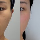 서면 | 서면피부과 피팅리프팅 내돈내산 후기
