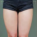 술살빼러 허벅지안쪽주사 신사역 지힐링스퀘어에서 간단하게 상담