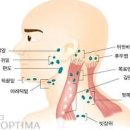 임파선 부었을때 증상과 치료법 및 붓는 이유 멍울 통증 등 이미지