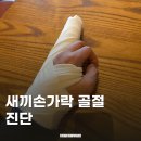 25시카센타 | 새끼 손가락 골절 수술 후기, 1탄 _진단