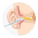 태평참이비인후과의원 | 이비인후과 귀지제거 비용은 어떻게 될까?