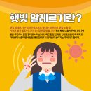 여름철 불청객, 햇빛 알레르기 이미지