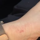 천안한의원 | 천안 아산 한의원 아토피 치료 솔직 후기