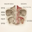 지산행복을 심는 치과의원 | 송도 치과 상악동 거상술 꼭 해야 되나요?