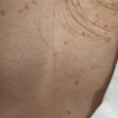 고려튼튼의원 | 청량리 자연튼튼의원 예약 가능할까? 쥐젖레이저 가격 쥐젖원인 쥐젖제거후 관리방법