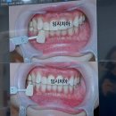 용당퍼스트치과의원 | 강남 치아미백 원데이 디퍼스트치과의원 치아미백 비용 합리적인 곳 강남 치아미백치과 추천 + 본식...