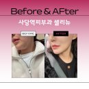 사당역피부과 셀리뉴 올리지오와 비교해서 받아본 솔직한 찐 후기!