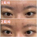 경남한의원 | [부산 서면 흉터치료 한의원 새살침] 수두흉터 패인흉터 2회차 생생후기