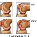 무릎 앞뒤 통증 원인 7가지 이미지