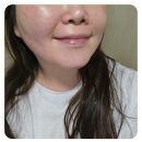 황수란피부과의원 | 홍대피코토닝 밴스의원에서 잡티제거 받은 내돈내산 후기!