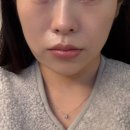 프라임 | 청담피부과 울쎄라 프라임 내돈내산 후기 💸✨