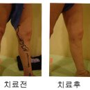 [인천 하지정맥류/인천]하지정맥류 수술전 후 사진 -63세 여자 이미지