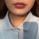 [뷰티/후기] 광교 리슈어스 의원 입술필러 내돈내산 후기(레스틸렌 키스)
