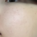 청담디어의원 | 청담디어의원 리쥬란 엠보 및 시술 전/후 비교 후기