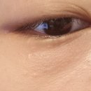 아그네스 통상 | [서울 광진] 건대입구피부과 눈 밑 한관종 제거 아그네스레이저 CO2레이저 부작용 주의사항 경과 후기