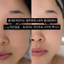 루엔차이 | 홍대윤곽관리는 엘루엔에스테틱 홍대점에서 시그니처 s-up작은얼굴 + 토네이도 하이푸로 사각턱 뿌시기