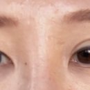 광고 x 부산 아이라인 문신제거 3차 후기