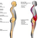 ﻿흉추후만(Kyphosis) 이미지