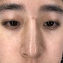 패인흉터 13탄 인천여드름흉터 지우개필 1차 후기