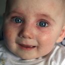 알레르기 이미지