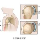 어깨 팔 통증 연골에 초점을 맞춰야 하는 이유 이미지