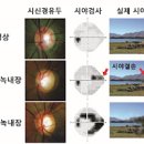 2030대 백내장과 녹내장 발병 원인 & 초기 증상 이미지