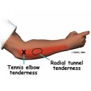 상완골 외측상과염(上腕骨 外側上顆炎, 테니스 엘보:Tennis elbow) 이미지