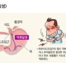 식도염초기 역류성 식도염 원인 이미지