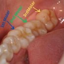 에이스치과의원 영등포문래동점 | 영등포 사랑니 - 문래동 사랑니 발치 통증 걱정된다면 꼭 읽어보세요