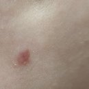 나음 | 나음피부과 여드름 압출 후기