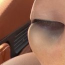 눈밑지방재배치 2주차 역대급 피멍 붓기 비수면재수술후기
