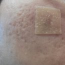 더이쁨풀의원 | 선릉역 피부과 더이쁨풀의원 여드름흉터 치료