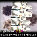 [허리디스크]허리디스크 치료에 약물요법이 꼭 필요한가요 ? 이미지