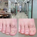 수락산역 5번출구 | 노원 내성발톱 초기 레푸스 수락산역점 무좀발톱 케어 관리한 후기