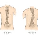 바테르증후군 뜻 원인 증상 바테르증후군 치료 바터 증후군 이미지