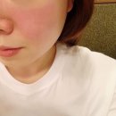 유앤영피부과의원 | 명동피부과, 3DEEP 리프팅 내돈내산 후기