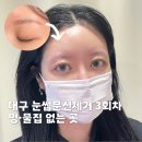 반월당역서한포레스트경로당 | 대구 눈썹문신제거후기 3회차 회색 붉은잔흔까지 아멜리아뷰티 반월당점