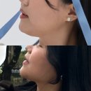 낱낱이 봄;내_일적 | 대구피부과 온다리프팅 내돈내산 후기 가격 통증 효과 상세한 정리해봄