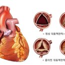 대동맥판막협착증 관리 이미지