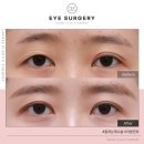 [실환 케이스] 절개쌍꺼풀 겹주름, 비대칭, 흉터 재수술