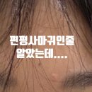 다산지금약국 | 다산 피부과 후기 편평사마귀인 줄 알았는데…? 피지선증식증 제거한 내돈내산 솔직 후기