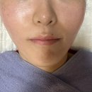 시솔 | [skin/진주] 진주피부과 실펌엑스+레스노베 엑소좀 스킨부스터 후기