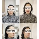 창원땅콩 | 창원피부과 스컬트라 후기｜팔자주름·땅콩형 얼굴 고민, 자연스럽게 볼륨 채우기
