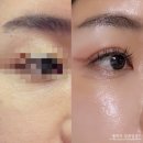 해주여관 | 신사역 피부과, 눈밑꺼짐 고민이라 울트라콜 200 볼륨 부작용 없이 받은 후기! 붓기 주기