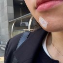 숨은그림성형외과의원 | [내돈내산] 점 레이저 후 튀어나온 흉터 제거 후기(함희정 성형외과의원)