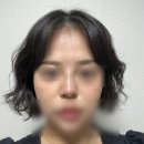 (주)지피코 1공장 | 창원 하이코 슬라인코 리프팅 내돈내산 솔직 후기 (전 후 사진)