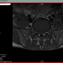 허리 MRI 판독소견서입니다. 잘 아시는 분들 좀 도와주세요. 이미지