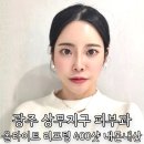 400 | 광주 상무지구 피부과 올타이트 리프팅 400샷 내돈내산 만족후기