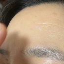 여자 m자 이마 맞춤 탈모케어한 후기