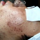 모아드 | [건대 피부관리 모아드] 무리한 자가 압출로 무너진 피부 장벽, 붉은 자국 색소침착 3개월 복구 후기
